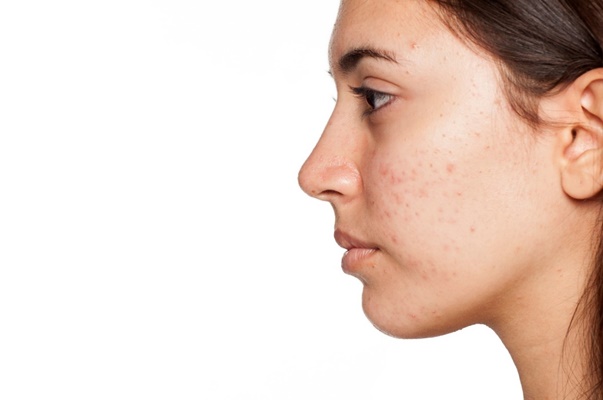 ch-skin-aging-and-hyperpigmentation